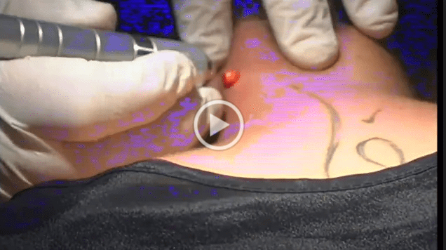 BLUE DERMA Treatment - K•Laser